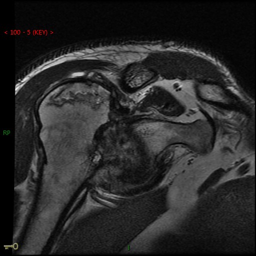 Figure 5 for case Chronic posterior glenohumeral dislocation ( RID4770 )